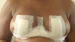 5 days after surgery