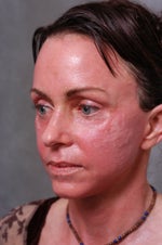 20 days after procedure, scarring resulted.