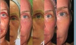 Day 1-6 Its only half of my face because I wanted to respect my privacy and be helpful at the sametime.