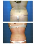 2 weeks post-op before and after photos