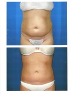2 weeks post-op before and after photos