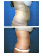 2 weeks post-op before and after photos