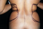 pre-op (larger on left side) 
