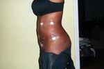 2 days post-op