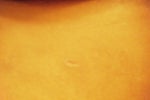 scar below my left breast (center of photo)19 days post-op, barely visable