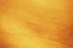 scar above my left thigh (center of photo) 19 days post-op