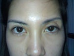 hollow eyelids due to failed asian blepharoplasty