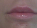 The day after injections (upper lip is still pretty swollen)