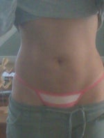 3 months post op 