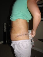 7 days after. Still bruised from Lipo