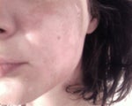 burned side, you can see the spot on my high cheak bone where it is beginning to peel prematurely.It might leave a scar. I scratched during the night unintentionally.  