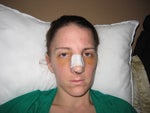 3 days post-op front (not at my best!)