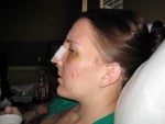 face, cheeks & bridge very swollen!