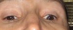 My eyelid has retraction and does not close all the way. Too much skin was removed on my left upper eyelid. 