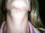 Chin scar and loose skin on neck