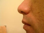 3 Days Later - some peeling is taking place