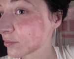 burned side. Not the prettiest of sights.