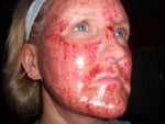 4 hours after deep fx procedure
