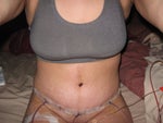 Post Tummy Tuck - Day 7