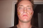 5hrs After - Starting to crust up and ooz blood
