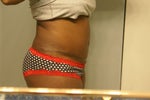 my scar at 6 weeks