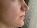 Small scar on the cheek on the left
