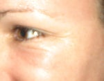 after one fraxel:restore, next day- smiling... puffy though