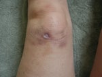 left knee showing scarring 3 months after