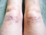 3 months after procedure 