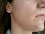 Small scar on the cheek on the left