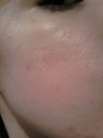 Small scar on the cheek on the left