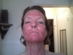 four days post-procedure
