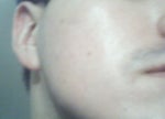 After - Skin didn't stay like this for long, nor is this photo hugely representative of my result. It was a 2.0mp cell phone camera.
