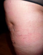 09-25-08 Day 1 The little dent on the right leg after the procedure on the outer thighs