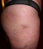 09-25-08 Day 1 The little dent on the right leg after the procedure on the outer thighs