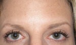 after eye surgery 2 mos, still a little puffiness in left eyelid