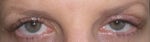 after eyelid surgery day 12