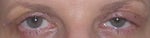 after eyelid surgery day 9