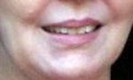 before lip implants