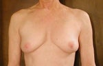Before Implant Surgery