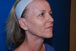 Before Procedure, No makeup facial or eye