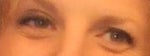 before eyelid surgery