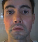 Before upper and lower mini face lift