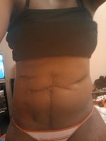 Before--multiple scarring