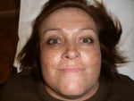 Before blue peel