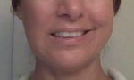 After botox injection