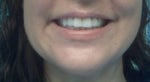 3 months and 5 days later, smile is getting better!!