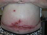 A Hard Swollen Abd. 6 months Post Smart Lipo.  The underwear use to ride at my hips!
