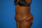 before tummy tuck surgery