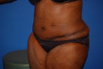 After tummy tuck surgery